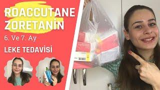 ROACCUTANE ZORETANİN 6.7.AY 60MG TEDAVİM BİTTİ LEKE TEDAVİSİFOTOĞRAFLAR #roaccutane #zoretanin