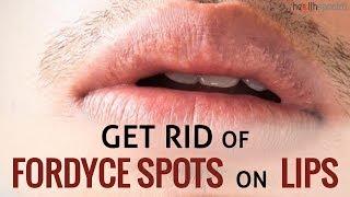 12 Ways To Get Rid Of Fordyce Spots On Lips  Healthspectra