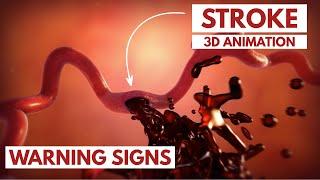 How to Recognize a Stroke?  3D Animation