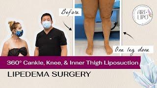 360° Cankle & Knee Liposuction  Lipedema  Artlipo  Expert Dr. Thomas Su