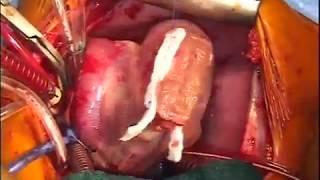 Surgical Repair of Cantrell’s Pentalogy With a Left Ventricular Diverticulum