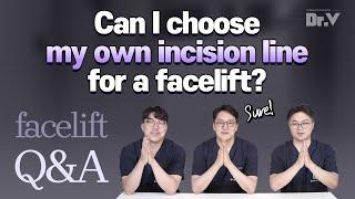Can I choose my own incision line for a facelift?