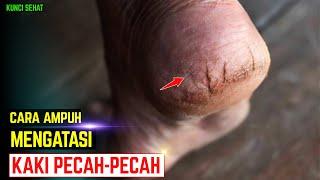 Kaki Pecah-Pecah  Ini 9 Cara Ampuh Mengatasi Kulit Kaki Pecah-pecah