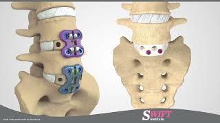 Anterior Lumbar Interbody Fusion ALIF in Reno Nevada - Minimally Invasive Spine Surgery