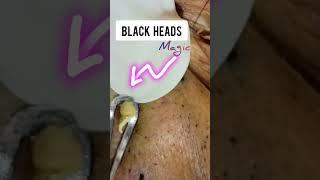 Blackheads magic #blackheads #blackheadremoval @Dr.AMAZINGSKIN