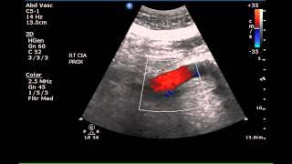 Sonographic Demonstration of Ectasia of the Iliac Arteries - Case Study