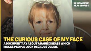 Dermatochalasis A rare disease makes people look decades older Documentary