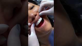 Sorriso Natural com Lentes de Contato Dentais de Porcelana Emax #dentista #dentistaaguaclaras #df