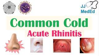 Common Cold Acute Rhinitis  Causes ex. Coronaviruses Risk Factors Transmission Symptoms