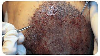 Watch the Full FUE Hair Transplant Procedure in a 60 Second Time Lapse