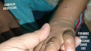 Clinical video Rash on palm hands n legs