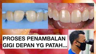 Proses Penambalan Gigi depan yang patah  Tambal Gigi  Dokter Gigi Griya RR