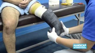 Video 2 - Transtibial Socket Fabrication for Interim Prosthesis