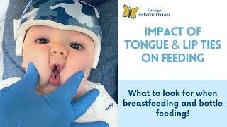 Tongue & Lip Ties what to look for when feeding
