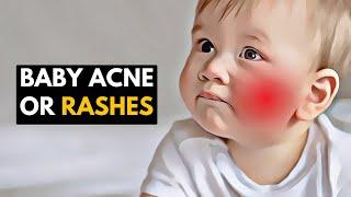 Gentle Care for Little Faces Managing Baby Acne and Rashes