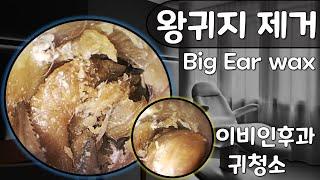 귀팡 왕귀지 청소 Big Ear wax removal 초고화질 HD endoscope