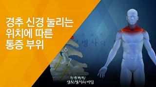 경추 신경 눌리는 위치에 따른 통증 부위 - 20140917_517회 방송_우리 몸이 흔들린다 목 질환의 경고