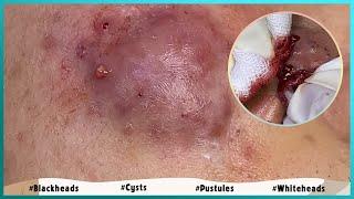 Big Cystic Acne Blackheads Extraction Blackheads & Milia Whiteheads Removal Pimple Popping