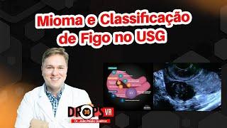 APRENDA RECONHECER E CLASSIFICAR OS MIOMAS I VOCÊ RADIOLOGISTA