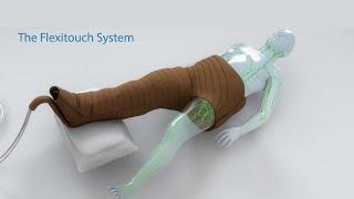 Treating Lymphedema - The Flexitouch System Lymphedema Pump