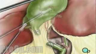 Gallbladder Removal Laparoscopic Surgery Patient Education