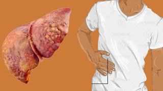 Cirrhosis Of Liver Life Expectancy By Stage