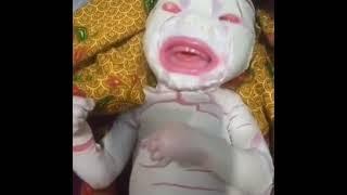 Video viral Bayi Di Tolitoli Diduga Lahir Dengan Kondisi Harlequin Ichthyosis.