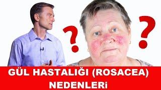 Gül Hastalığı Rosacea Nedenleri ve Tedavisi