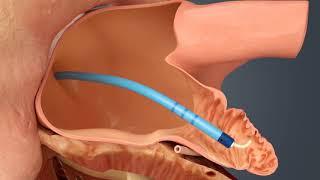 WATCHMAN Procedure for Atrial Fibrillation