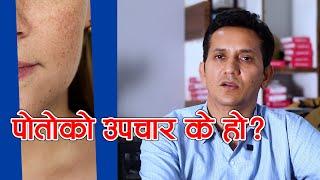 चाँया पोतो भएकाले गर्न नहुने १ गल्ती । पोतोको सहि उपचार ।  Dr. Achyut Pokharel  NIKO NEPAL