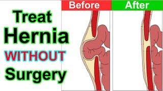 How to Cure Hernia Without Surgery  Hernia Treatment Natural Without Surgery