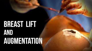 Breast Lift Mastopexy & Augmentation with Silicone Implants - Dr. Ruff  West End Plastic Surgery
