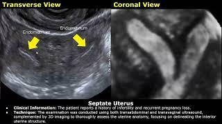 Congenital Uterine Anomalies Ultrasound Reporting  Didelphys Bicornuate Unicornuate Uterus USG
