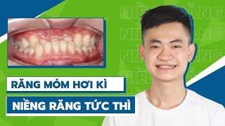 Nguyên nhân dẫn đến Răng khớp cắn ngược móm và cách giải quyết với Niềng răng