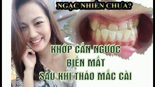 Kinh nghiệm niềng răng chữa cắn ngược lệch nhân trung nặng của Single Mom 32 tuổi.