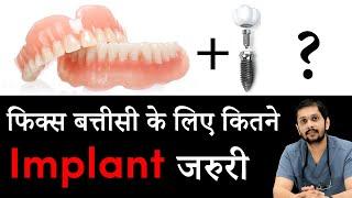 फिक्स बत्तीसी के लिए कितने implants जरुरी  How many dental implants are required for fix denture