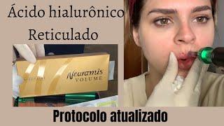 Preenchimento Labial na Pressurizada atualizado