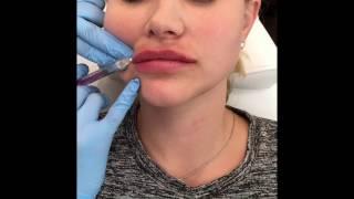 Juvederm Volbella Lip Filler Enhancment with Before and After Photos