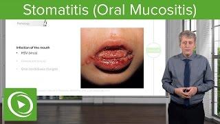 Stomatitis Oral Mucositis – Pediatric Infectious Diseases  Lecturio