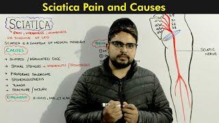 Sciatica Symptoms Causes and Treatments of Sciatic nerve