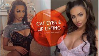 Chole London  Lip Lifting - Cat Eyes Surgery