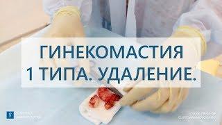 Гинекомастия 1 типа.  Удаление гинекомастии у мужчины.