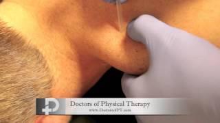 Trigger Point Dry Needling Local Twitch Response