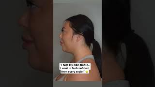 How To Lose Facial Fat  Buccal fat removal and chin liposuction #beforeandafter