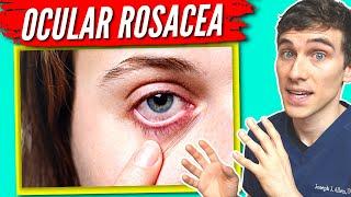 Ocular Rosacea Treatment - 7 Tips to Help get Relief