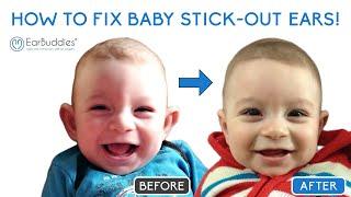 EarBuddies® - Fix your Babys Stick-Out Ears at Home