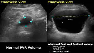 Pre Void & Post Void Residual Volume Bladder Ultrasound Normal Vs Abnormal Images  PVR USG