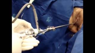 Endoscopic urethrotomy for failed urethrolysis in the female patient