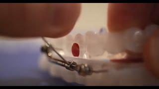 How to adjust the Dynaflex-Herbst oral appliance for snoring and sleep apnea.