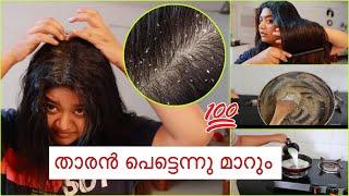 താരൻ പെട്ടെന്ന് മാറും ഇങ്ങനെ ചെയ്താൽ  How to Remove Dandruff at home Easily ️